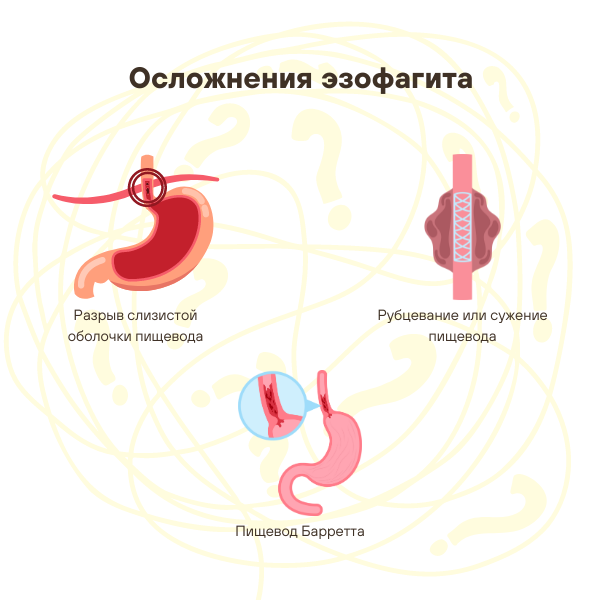 Осложнения эзофагита